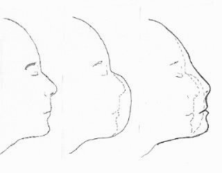 Lifemask Procedure